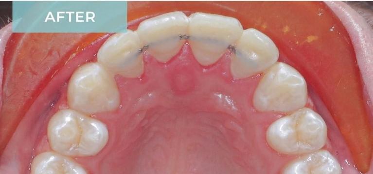 Orthodontics-After-Image