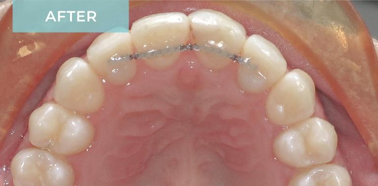 Orthodontics-After-Image